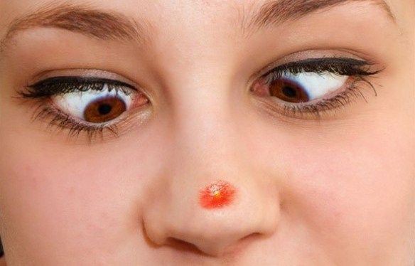 Ternyata Begini Cara Menghilangkan Jerawat di Hidung Secara Alami, Berikut 5 Cara Jitunya!